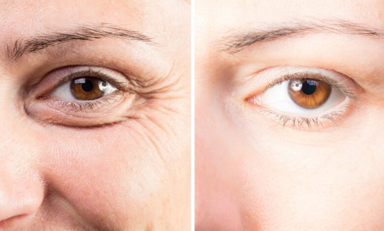 Eyelid Surgery